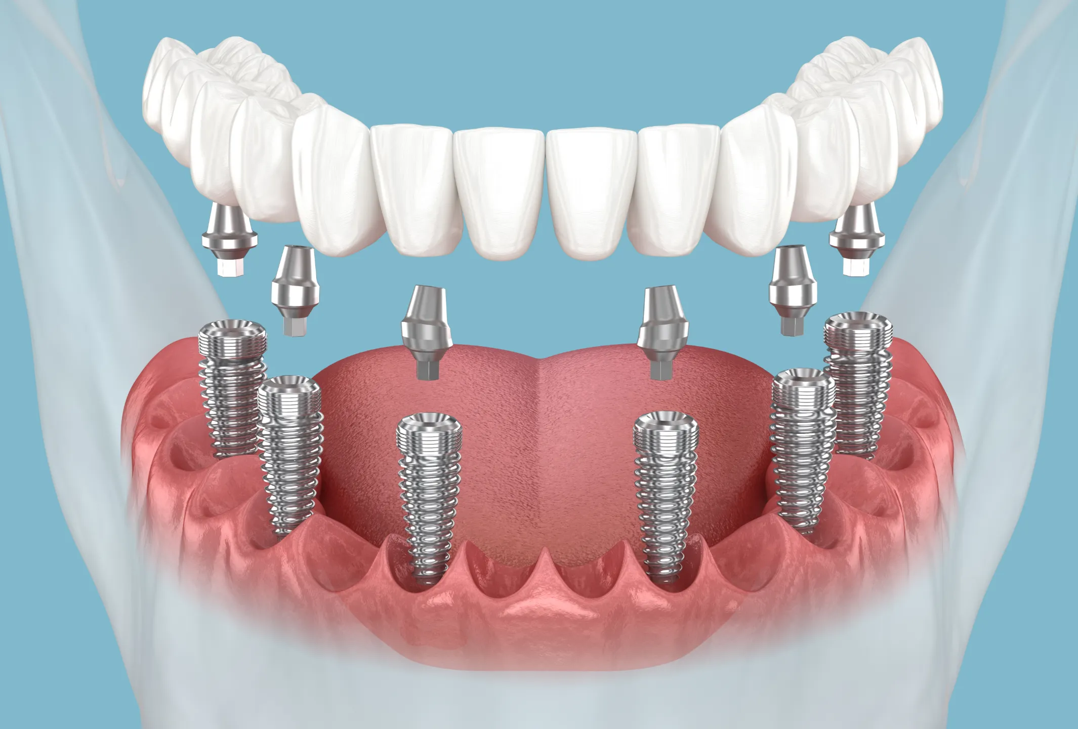 All-on-X & Full-Arch Dental Implants