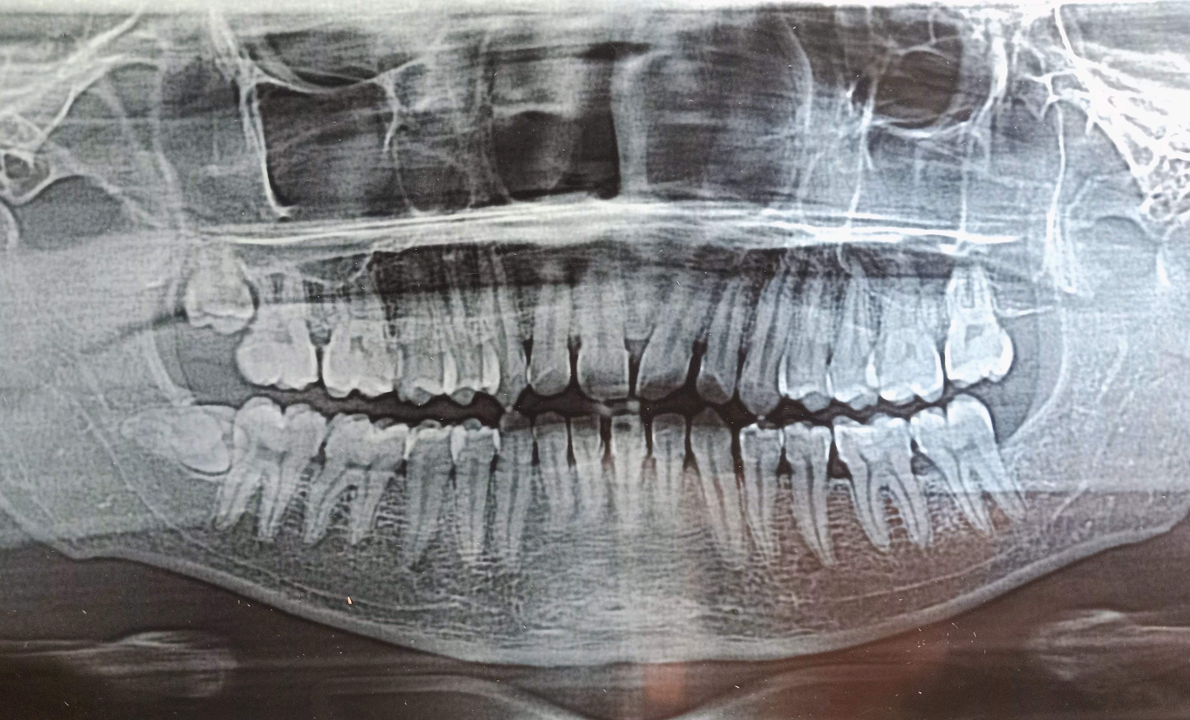 Panoramic dental X-ray showing upper and lower teeth and jawbone structure.