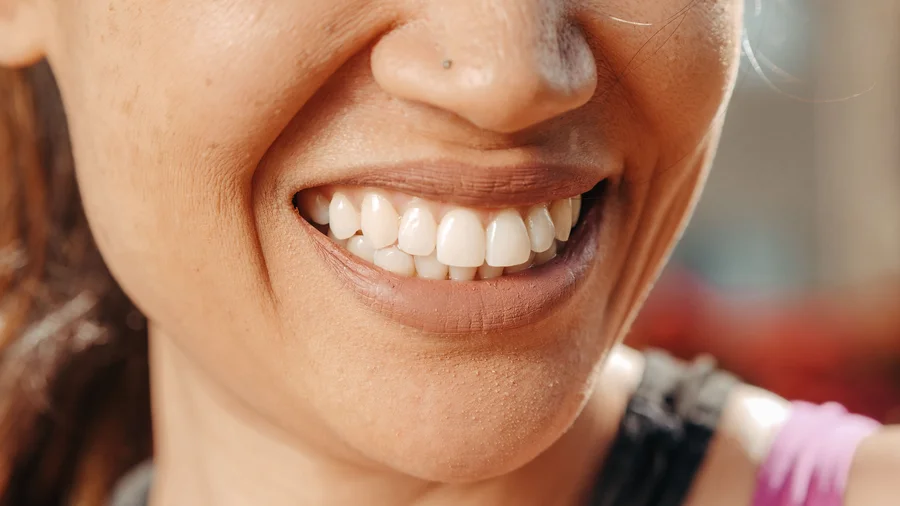 closeup-natural-smile-veneers-arkansas