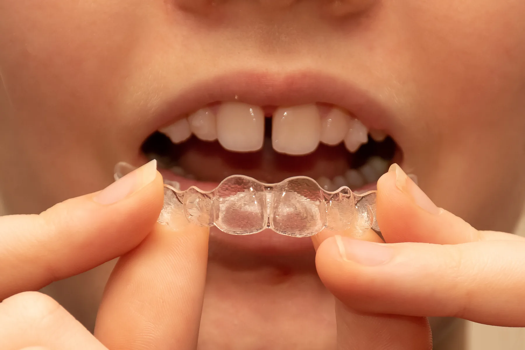 Close-up of a child placing a clear aligner over gapped front teeth