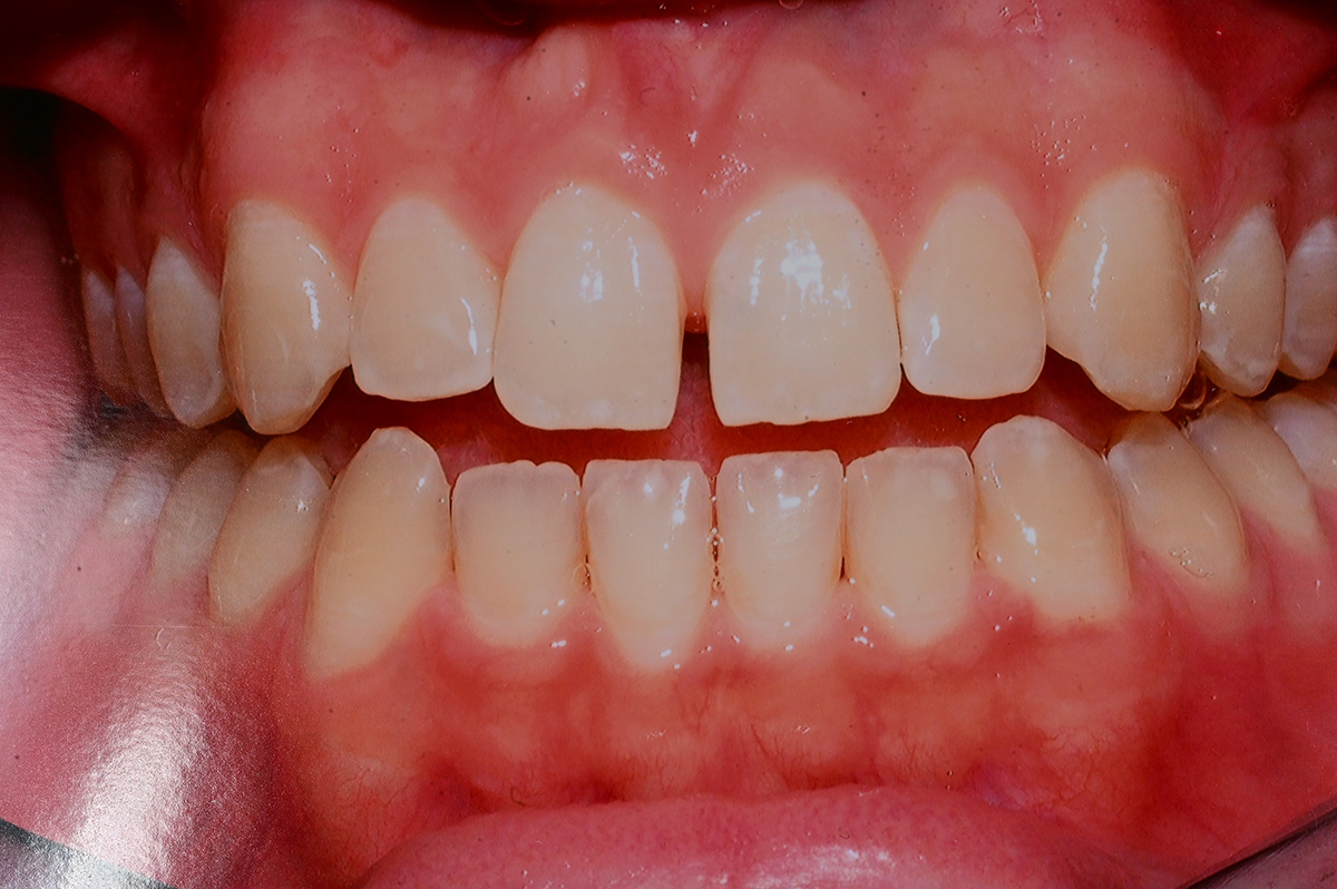 Close-up of a mouth showing upper and lower teeth with gaps and uneven alignment.