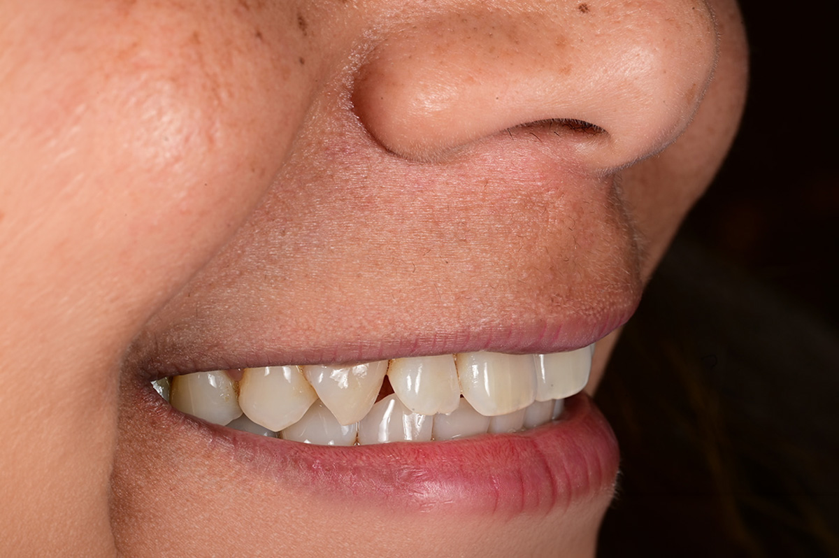 Close-up of a smiling person's mouth showing natural teeth with slight discoloration and gaps.