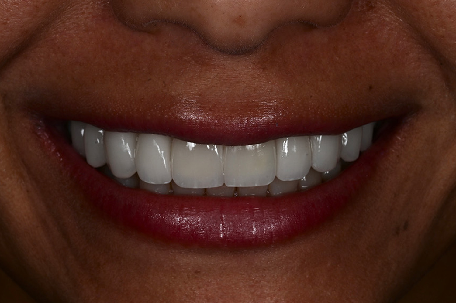 Close-up of a smiling person with bright, even, white teeth and natural lip color.