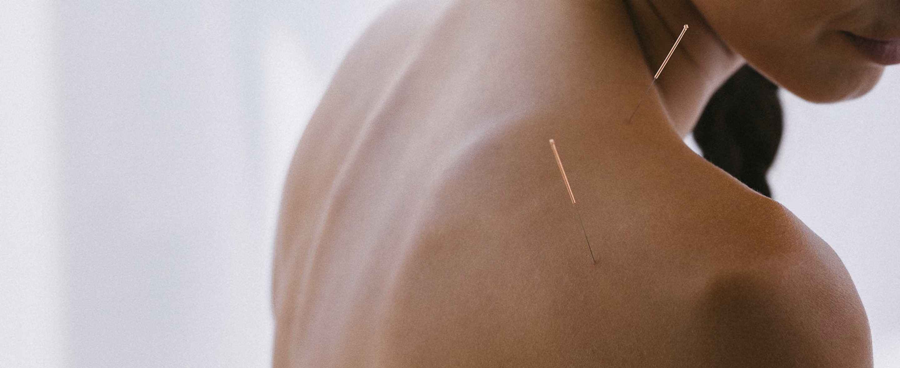 Nahaufnahme einer nackten Schulter und des oberen Rückens einer Person mit zwei Akupunkturnadeln, eine im Nacken und eine auf der Schulter.