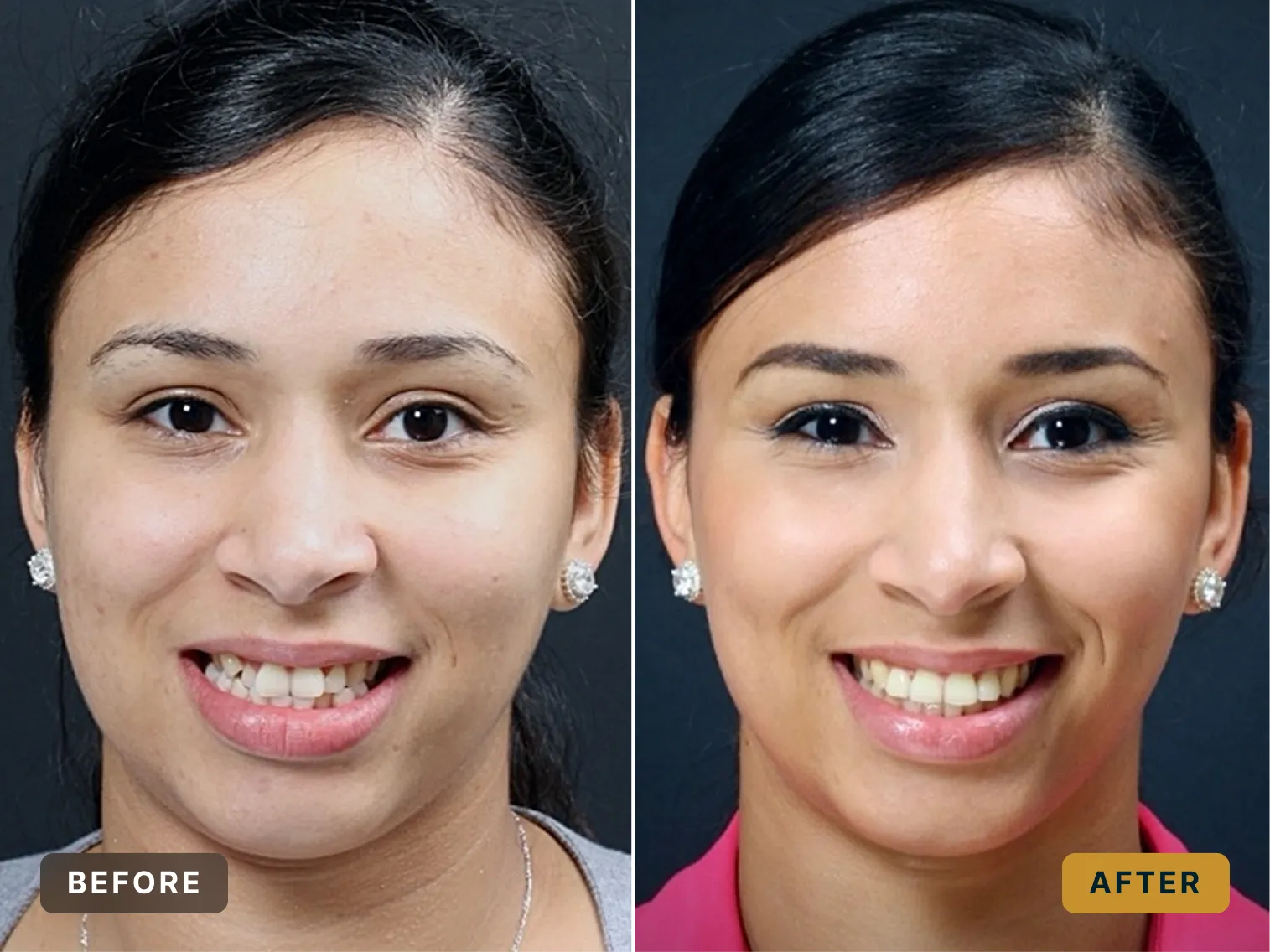 Side-by-side before and after photos of a woman showing teeth with improved alignment and makeup.
