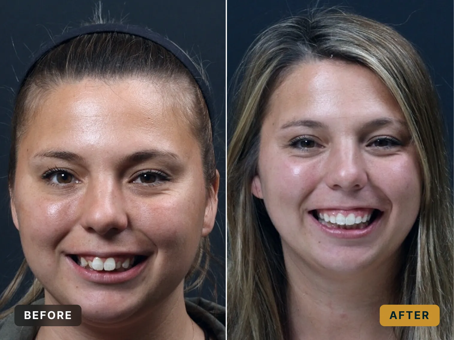 Side-by-side before-and-after portraits of a woman showing improved teeth alignment and smile.