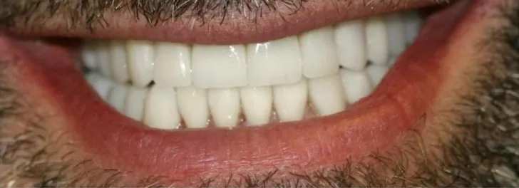 Close-up of a smiling mouth showing clean, white teeth and lips with facial hair around them.