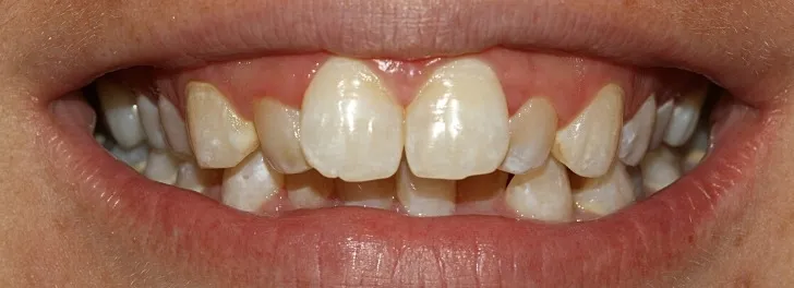 Close-up of a mouth showing uneven, spaced, and slightly discolored upper front teeth.