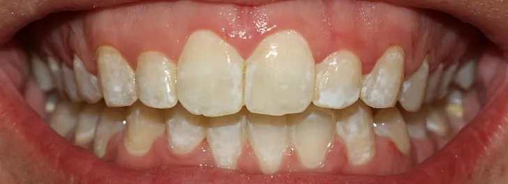 Close-up of teeth with white spots and some discoloration, gums visible around the teeth.