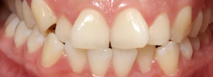 Close-up of misaligned human teeth with gaps and crowding in upper and lower jaws.