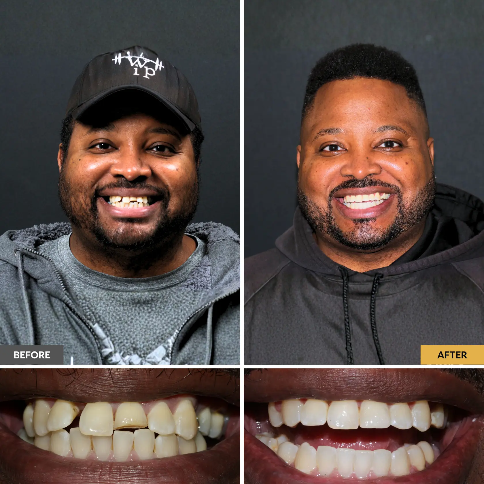 Before-and-after men’s smile transformation showing a fuller, brighter smile at Dental Care Stamford.