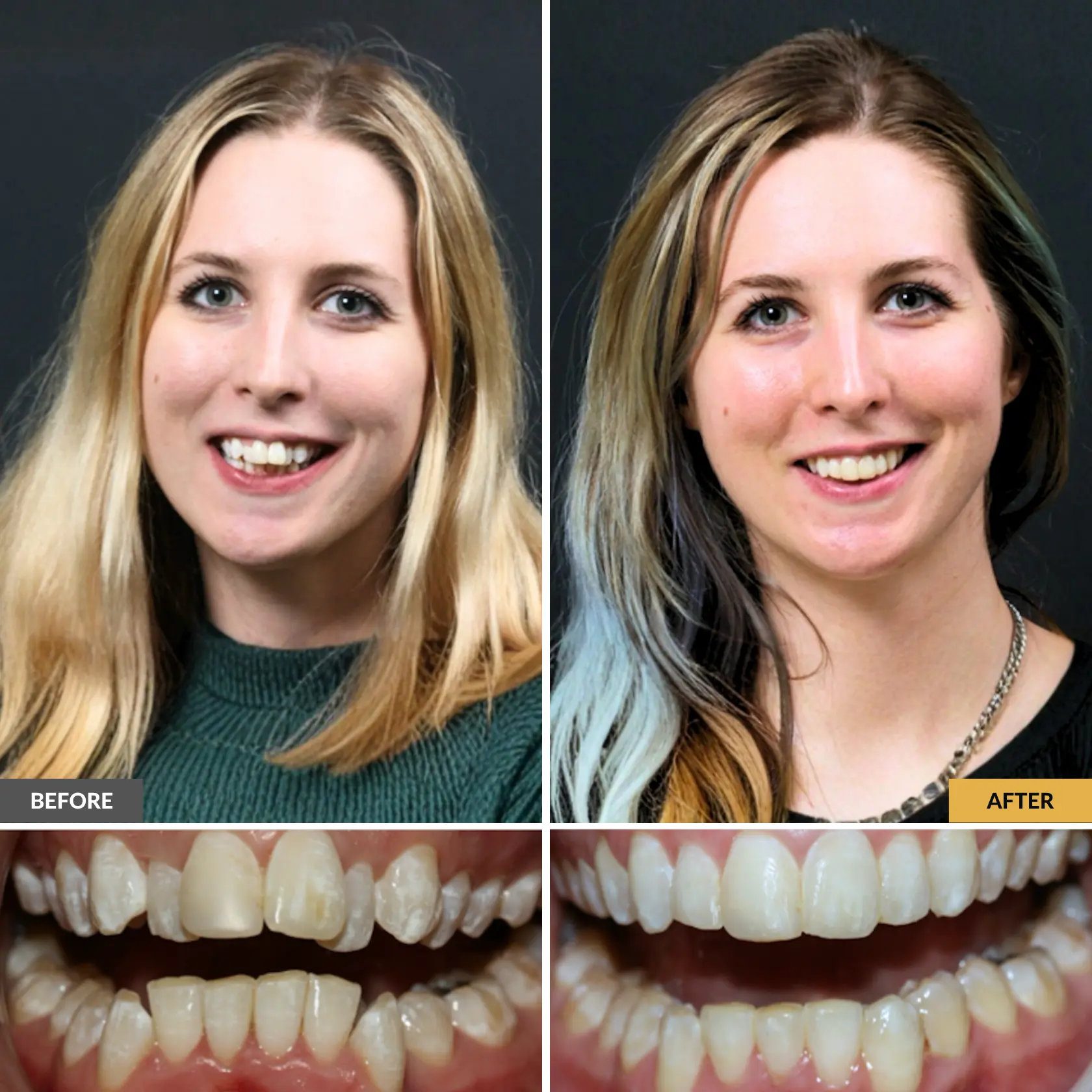Before-and-after six months smile (clear braces for adults)  treatment showing a woman’s improved smile at Dental Care Stamford.
