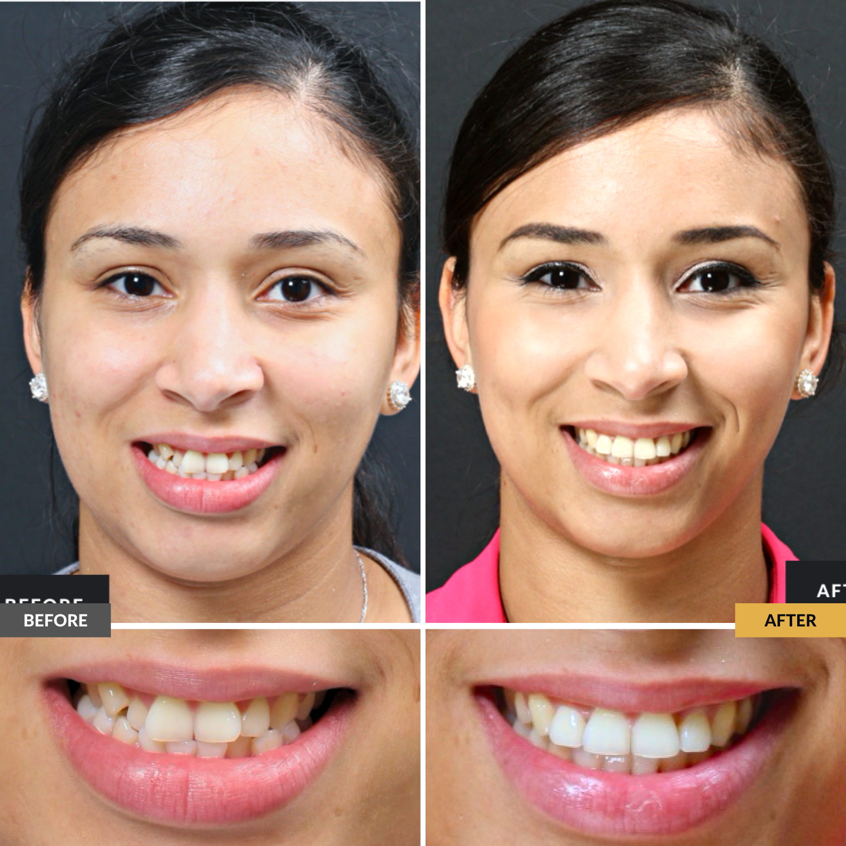 Before and after clear braces treatment showing improved tooth alignment and a more balanced smile at Dental Care Stamford in Stamford, CT.