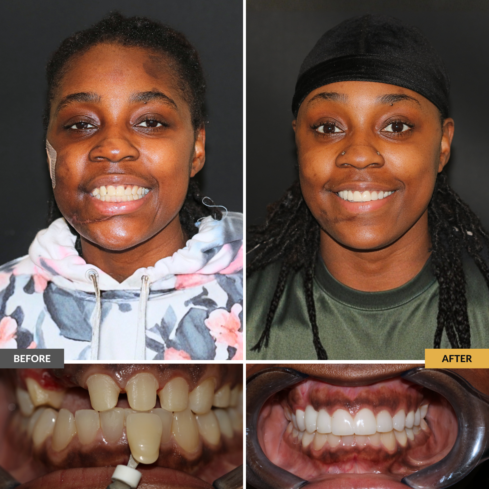 After a severe car accident this patient received emergency dental treatment at Dental Care Stamford. This is a before and after showing her restorative cosmetic treatment: a brighter, more confident smile
