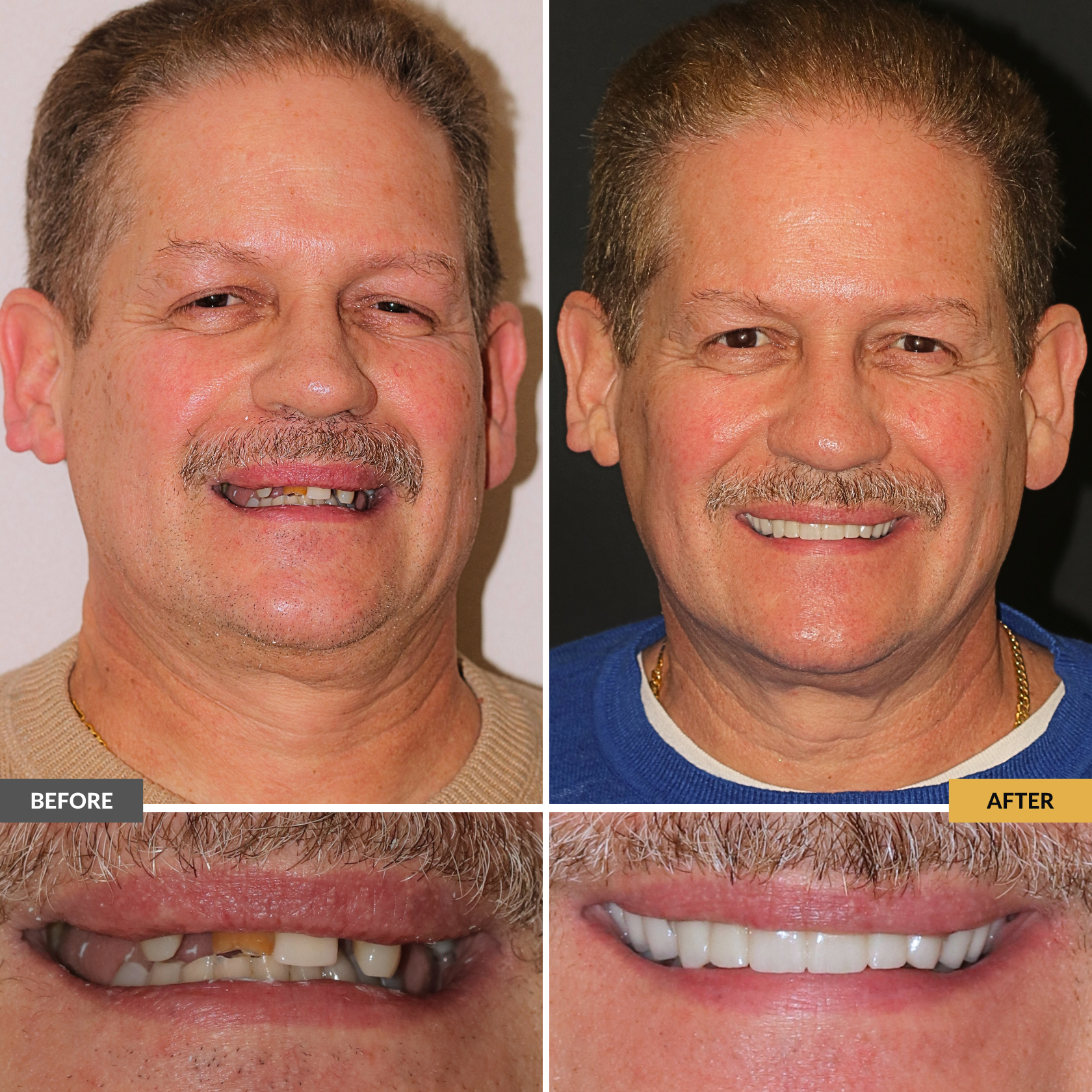 Before and after adult full restorative smile transformation showing improved tooth shape, alignment, and confidence at Dental Care Stamford.