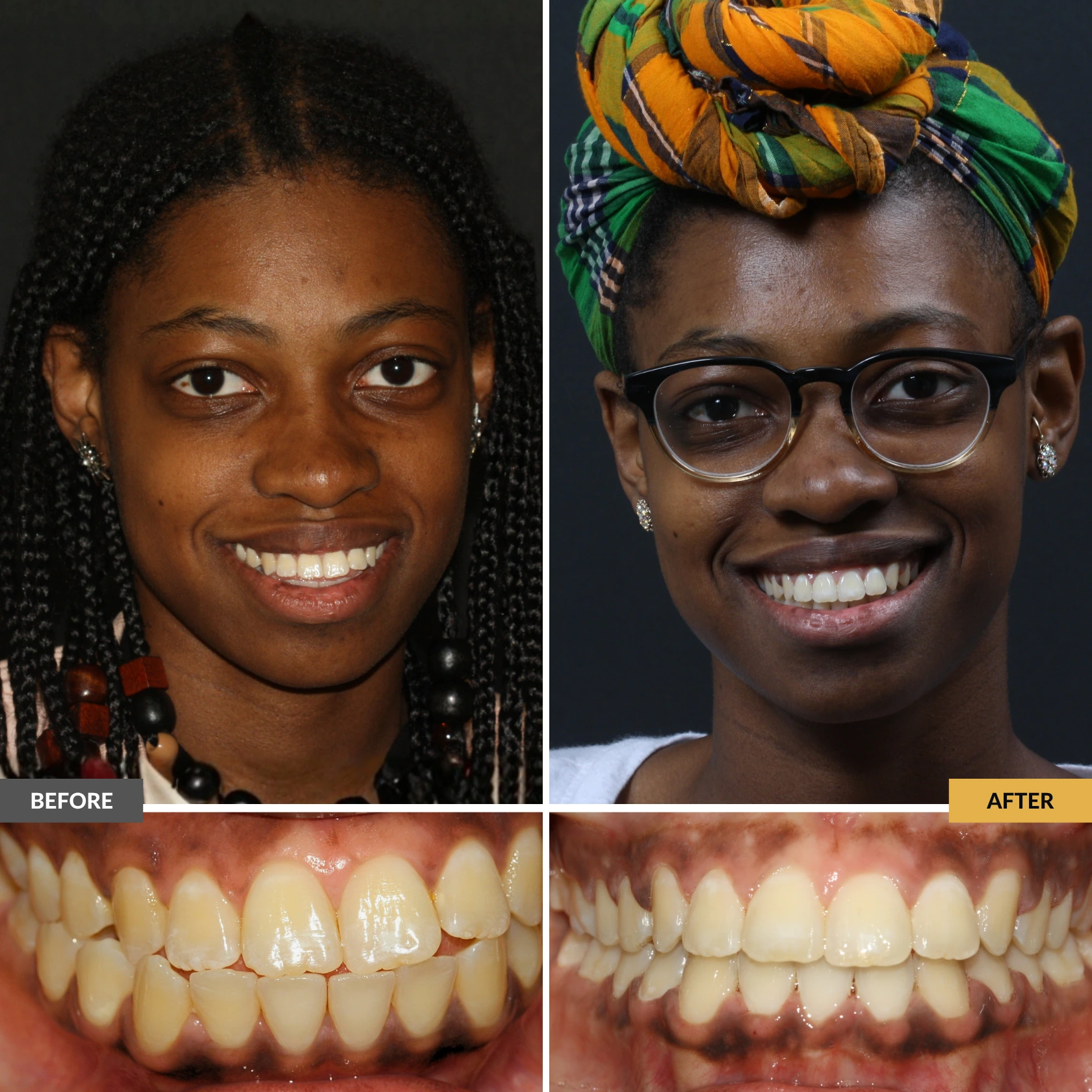 Before and after adult orthodontic treatment showing straighter teeth and improved bite alignment with clear braces at Dental Care Stamford.