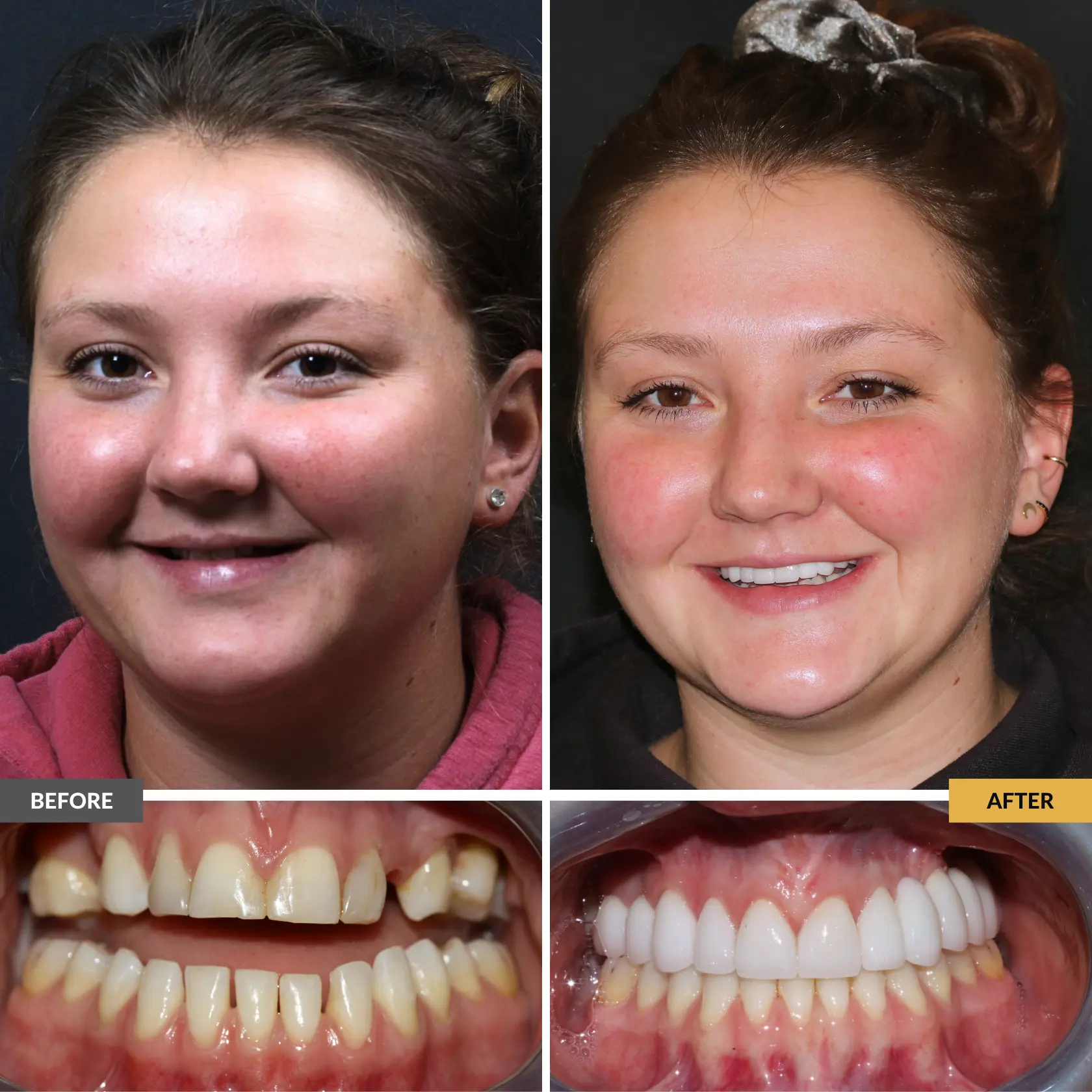 Before and after restorative smile makeover showing a healthier, brighter, more complete smile at Dental Care Stamford.