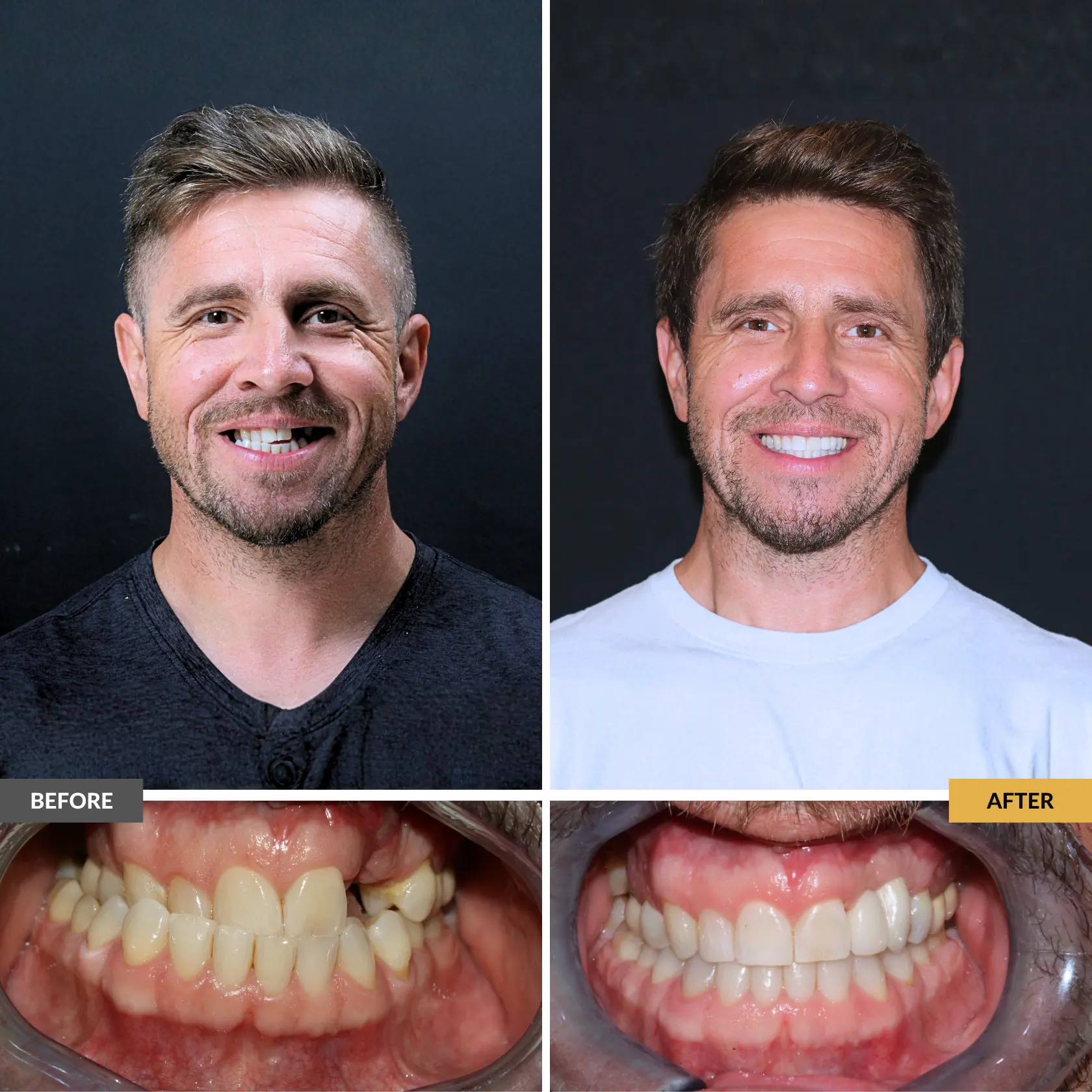 Before and after adult male after a combination a few cosmetic and orthodontic procedures to achieve his smile goals: dental implants, clear braces. Now showing improved tooth alignment and a more confident smile at Dental Care Stamford.