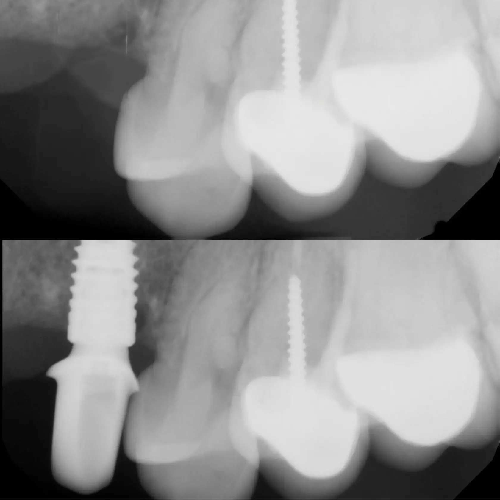 Dental implant X-ray showing restorative dental treatment planning at Dental Care Stamford in Stamford, CT.