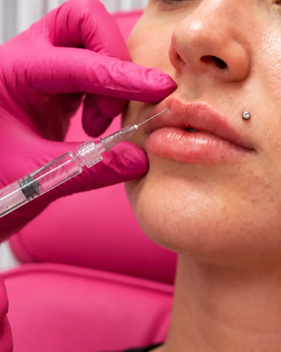 Magic Eraser: iniezione di ialuronidasi vicino alle labbra di una donna, con siringa e guanti rosa