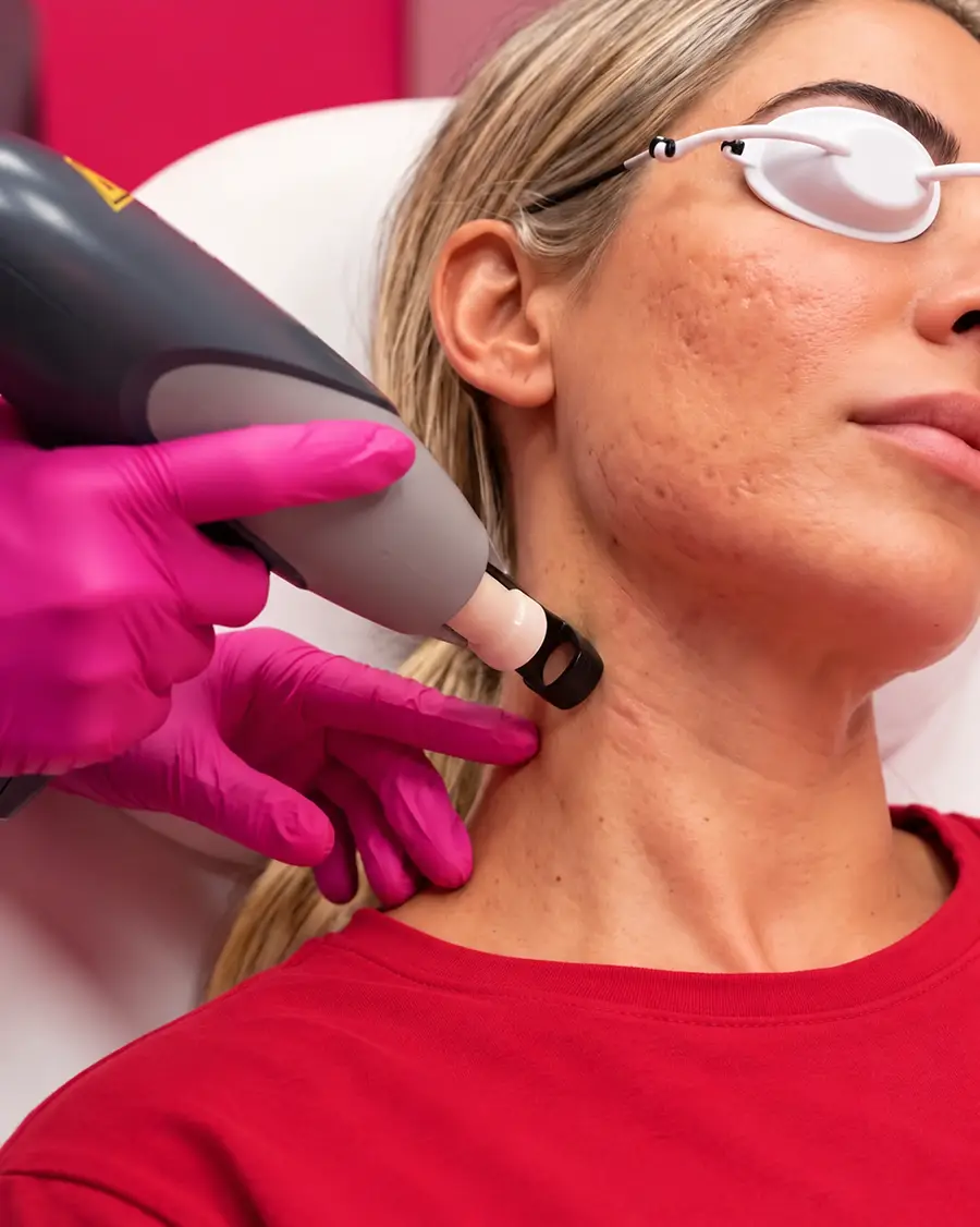 Laser Strong per cicatrici da acne, zona media: donna con occhiali protettivi mentre il laser tratta il collo