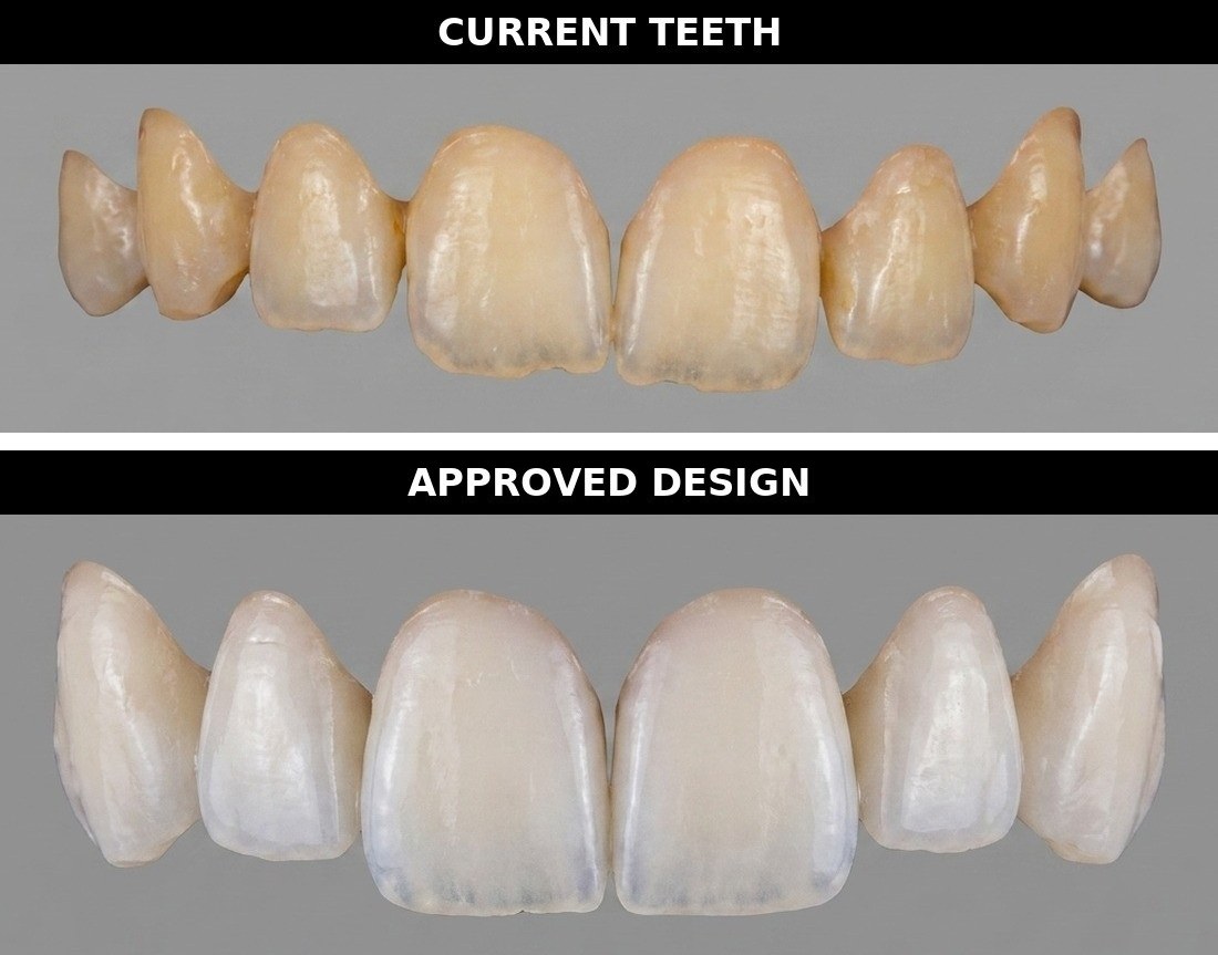 Two rows of isolated teeth on a neutral grey field: the patient's current teeth above, the approved veneer design below.