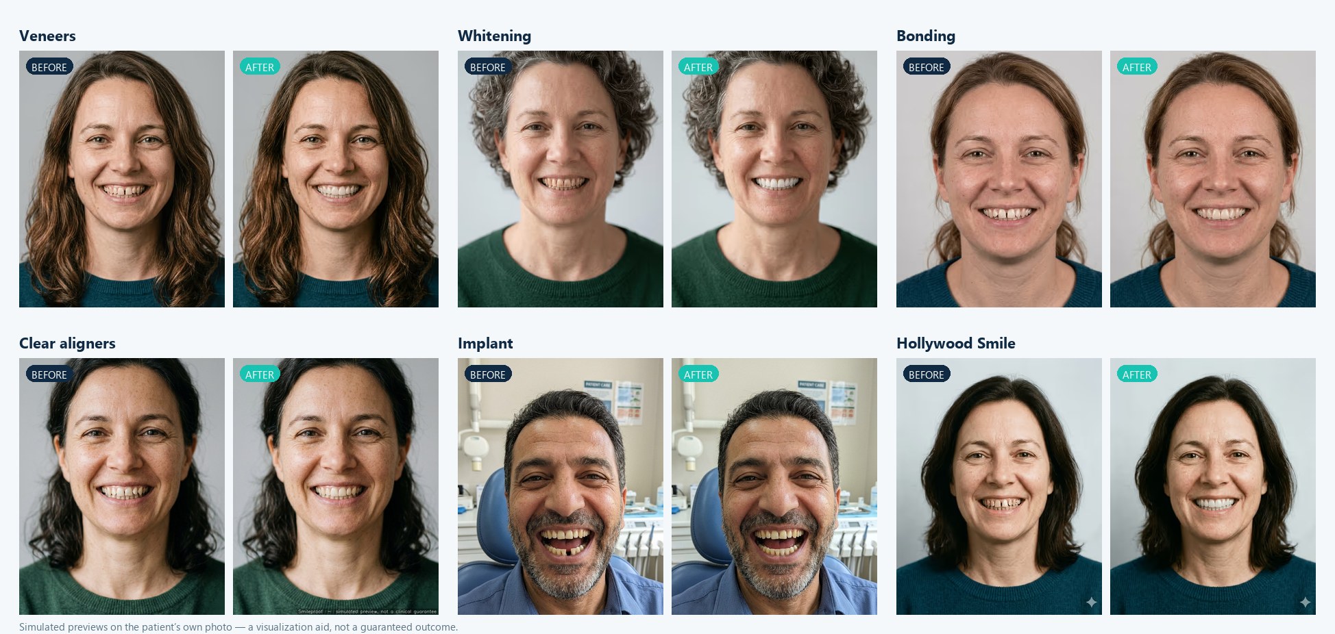 Before-and-after smile previews for veneers, whitening, bonding, clear aligners, an implant and a Hollywood smile on the patient's own face