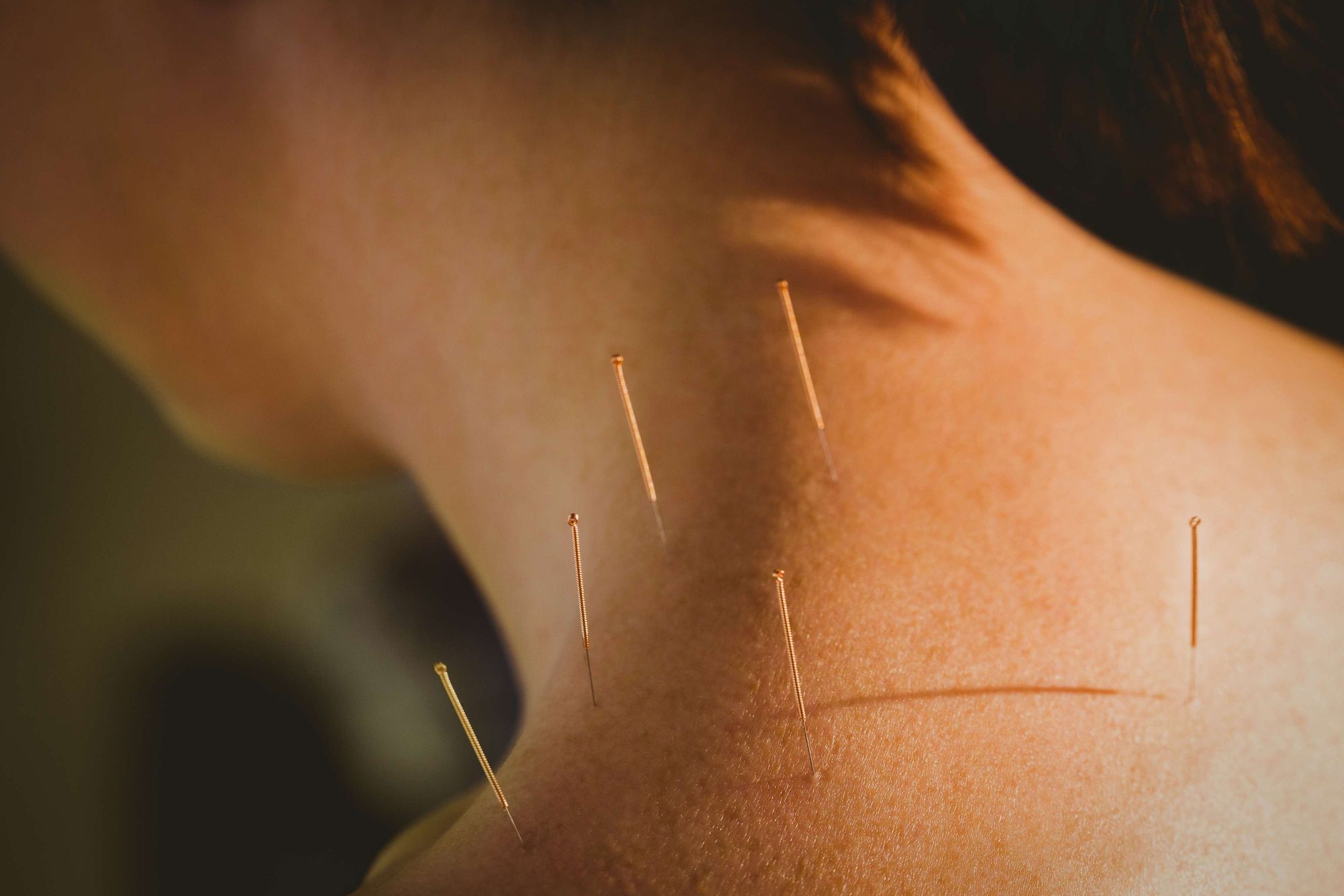 Acupuncture treatment in progress