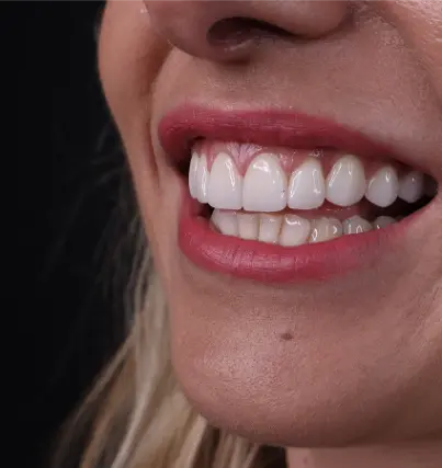 Paciente sonriendo tras tratamiento en Wikend Smile La Moraleja