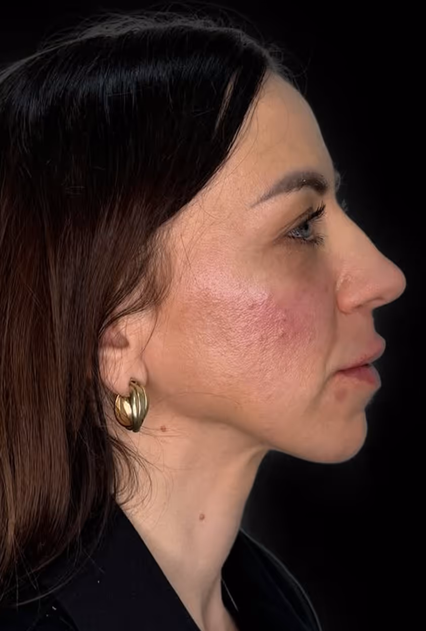 Close-up of a woman’s face with light skin, blue eyes, dark hair, and visible skin texture and redness.