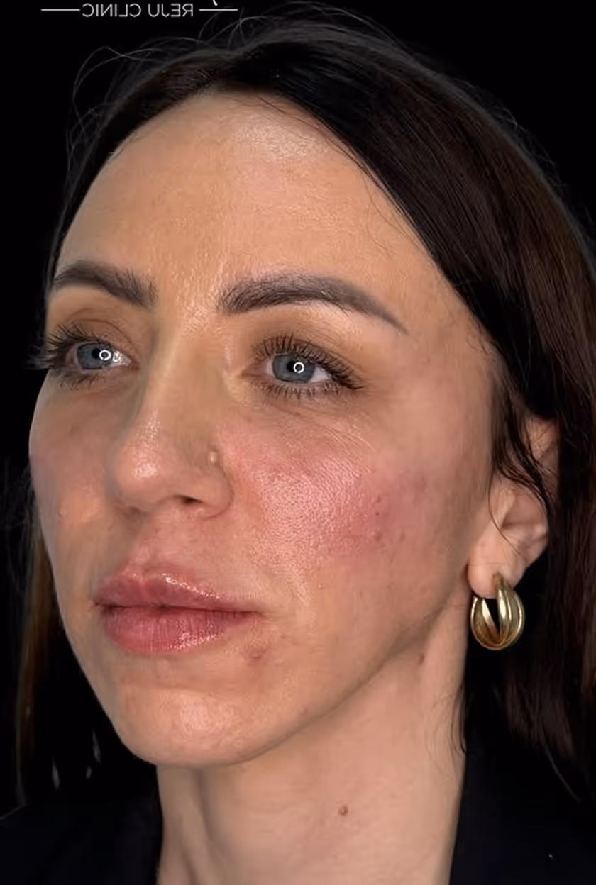 Close-up of a woman’s face with light skin, blue eyes, dark hair, and visible skin texture and redness.