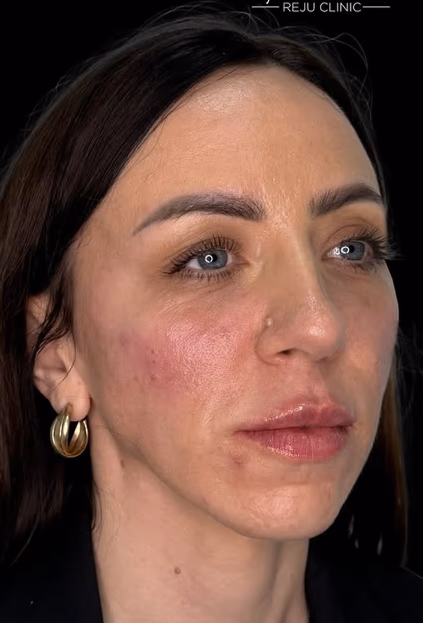Close-up of a woman’s face with light skin, blue eyes, dark hair, and visible skin texture and redness.