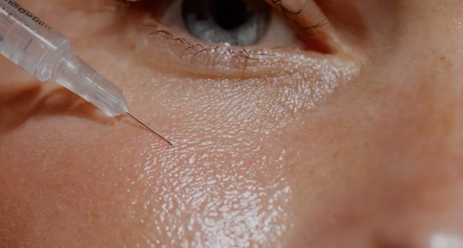 Close-up of a blue eye and skin with a syringe needle near the lower eyelid.