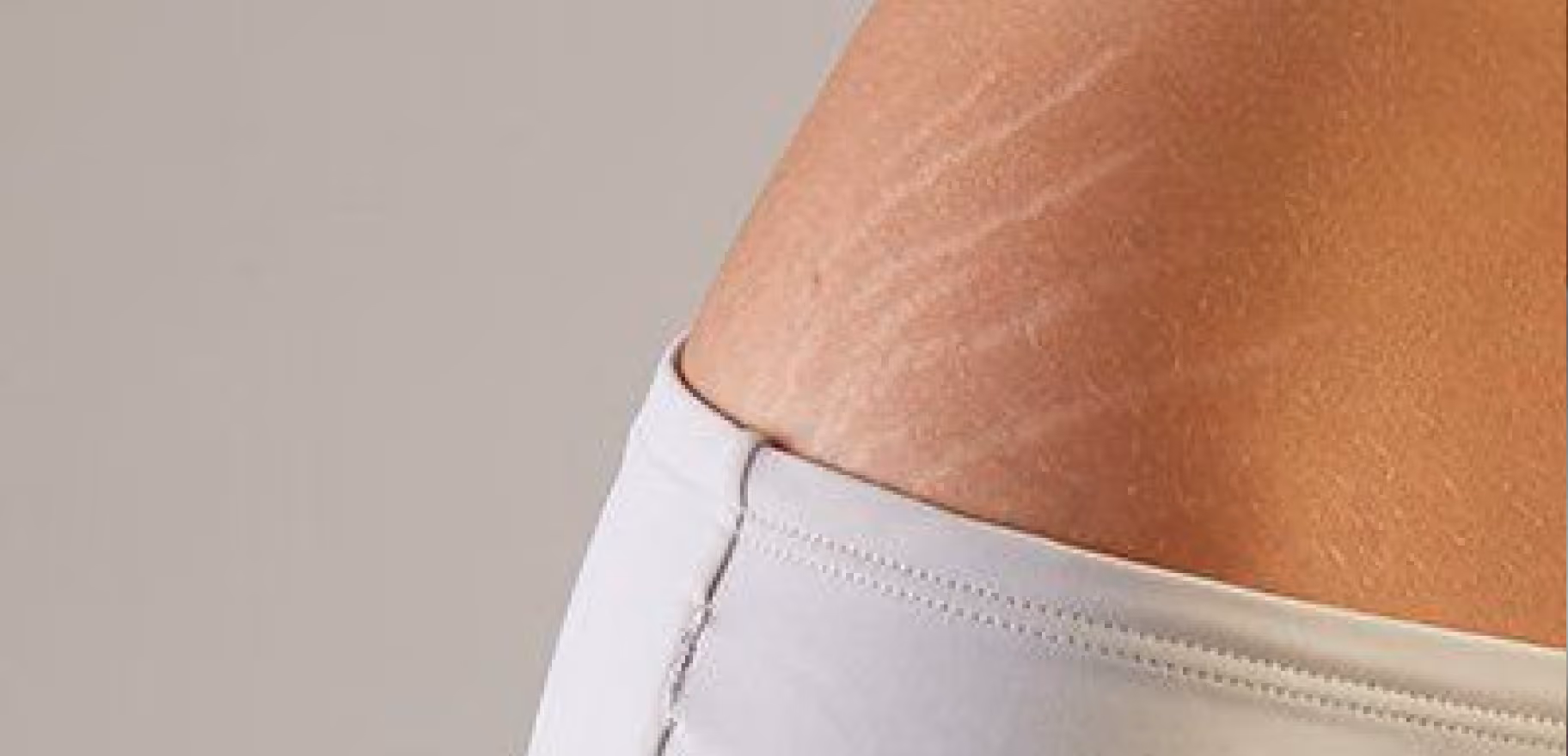 Close-up of skin with visible stretch marks near the waistline above white clothing.