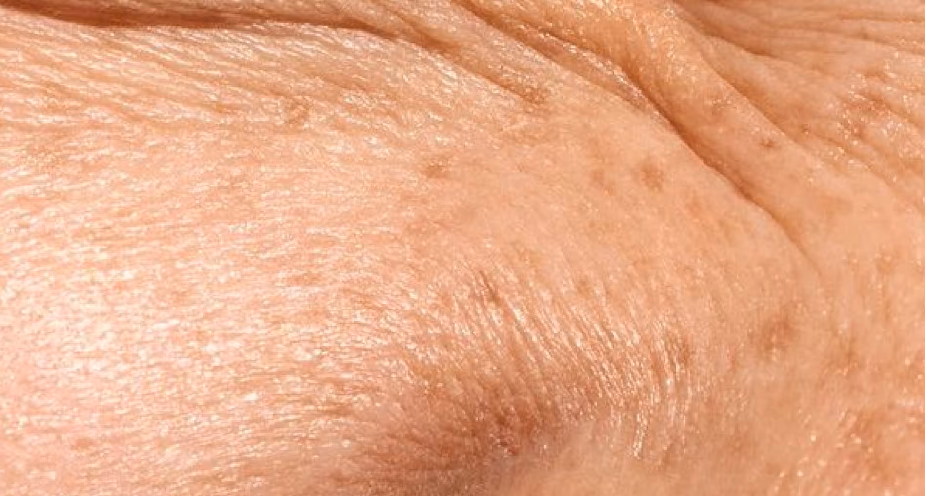 Close-up of aged skin with wrinkles and age spots.