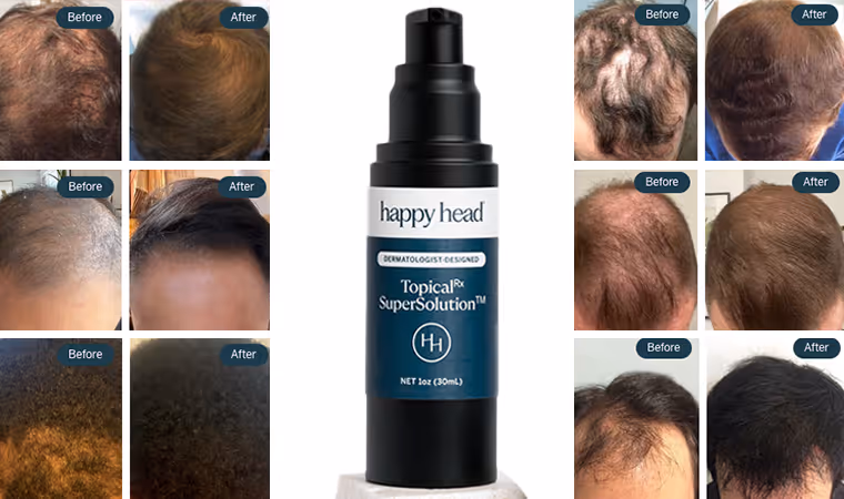 Before and after hair regrowth results