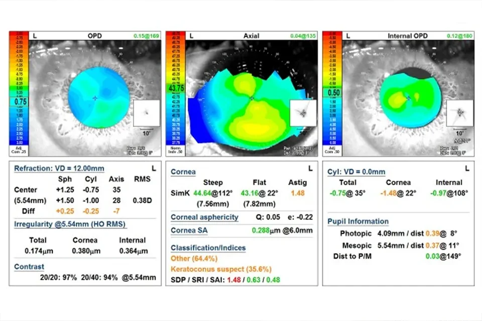 Infográfico comparativo mostrando um olho com cristalino opaco (catarata) e um olho com lente intraocular implantada recuperando a visão