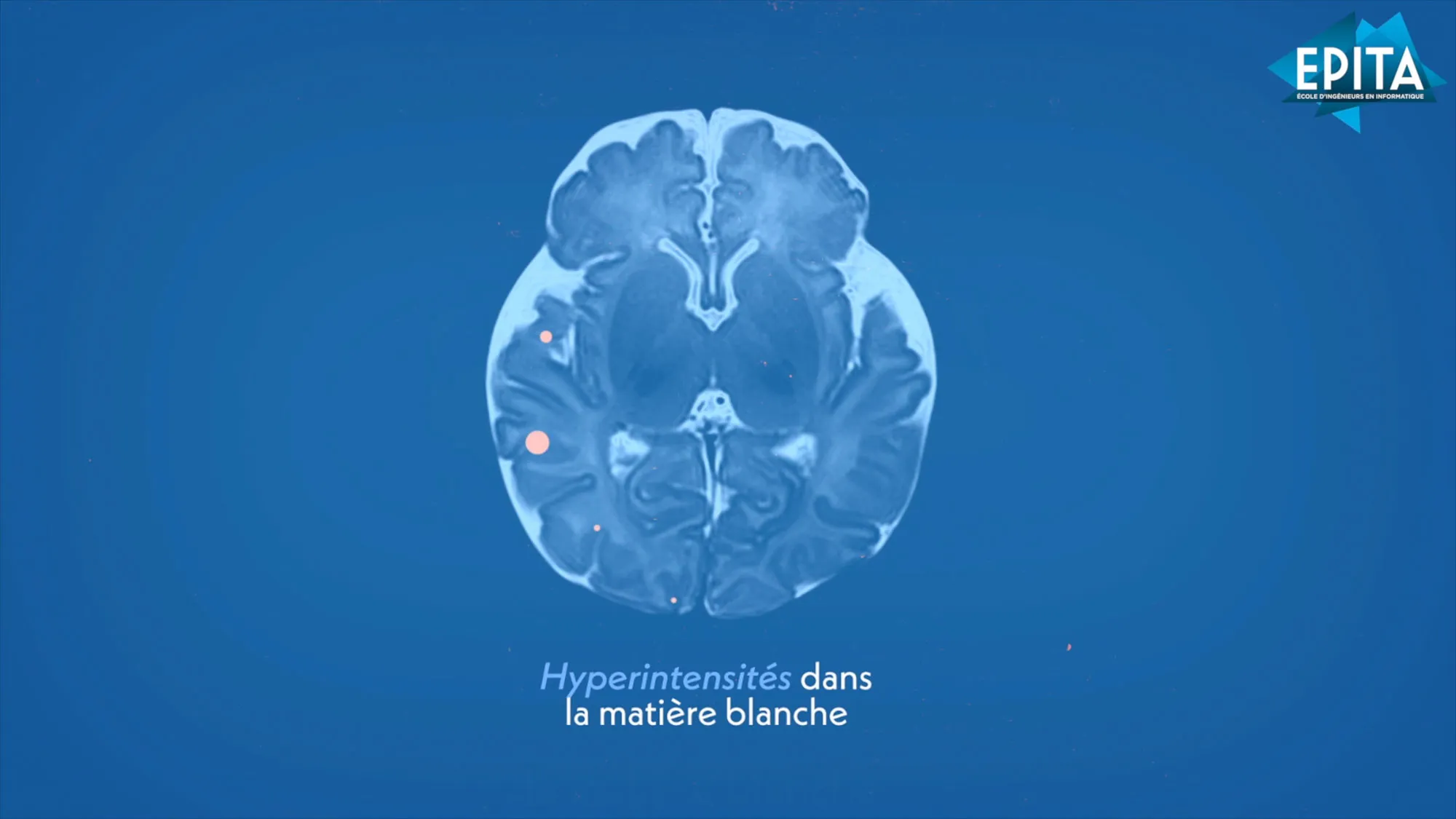 Une coupe d’imagerie cérébrale animée, avec une légende qui désigne une zone précise