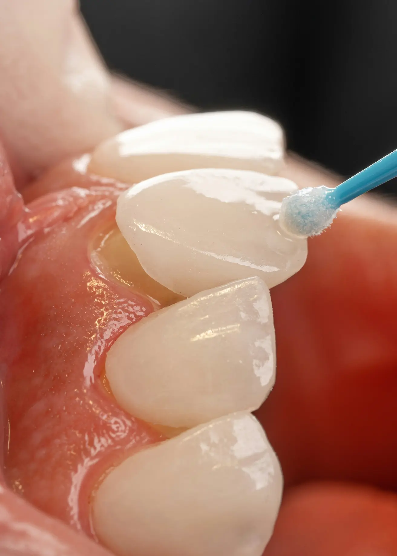 Close-up of dental veneer being applied to a tooth inside the mouth with a blue applicator.