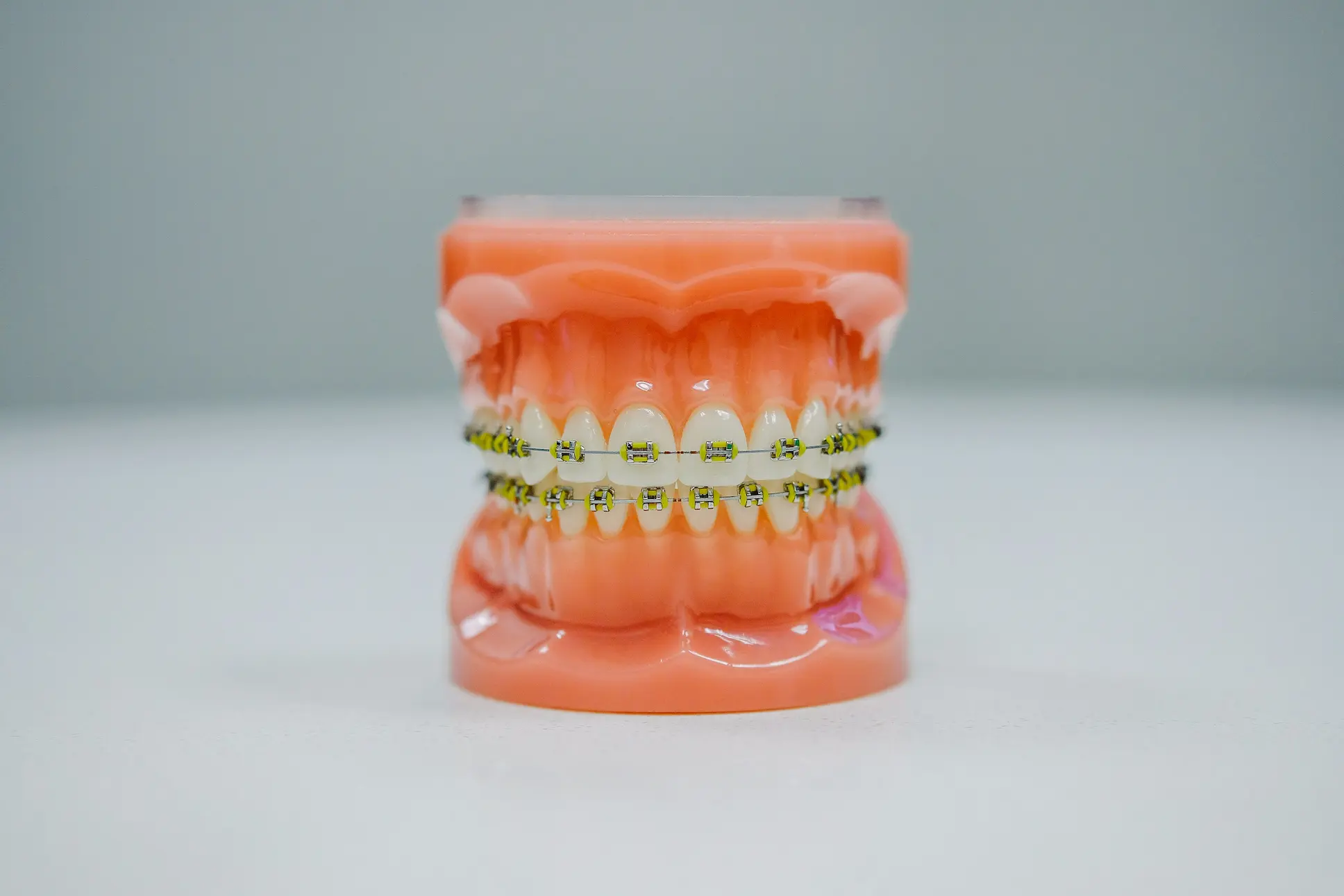 Dental model showing teeth with traditional metal braces and yellow ligatures.