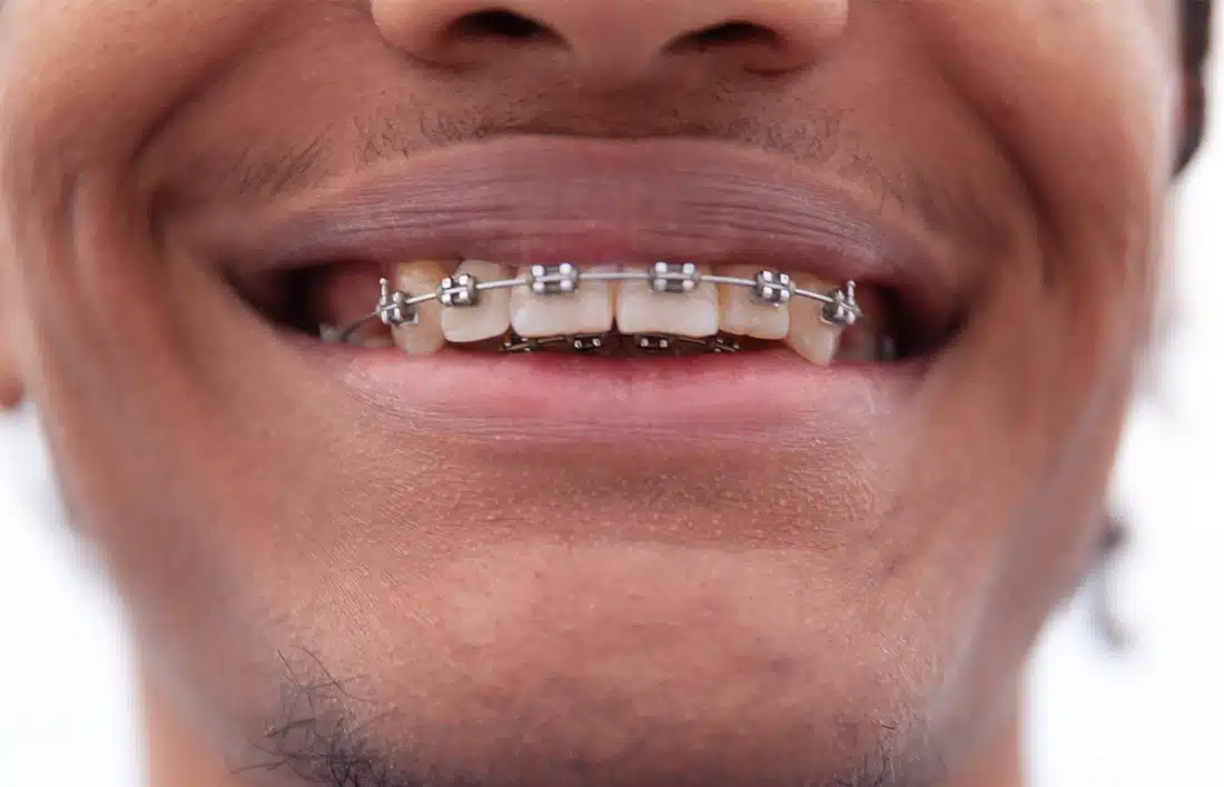 Close-up of a smiling person wearing metal braces on their upper teeth.