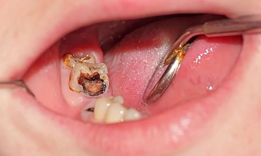 Close-up of a decayed molar tooth inside an open mouth with dental tool for examination.