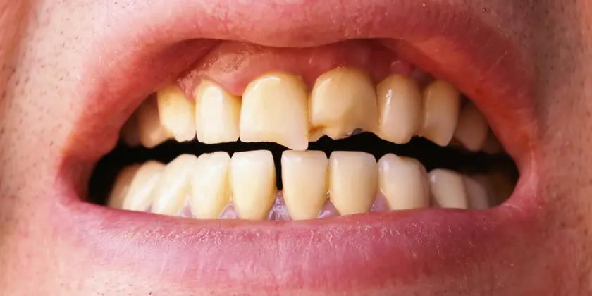 Close-up of a mouth with broken and chipped upper front teeth and slightly yellowed teeth.