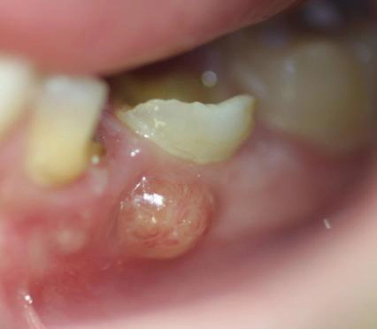 Close-up of swollen gum with a visible abscess near the lower molars inside the mouth.
