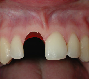 Close-up of an upper front gum with a missing tooth and surrounding natural teeth.