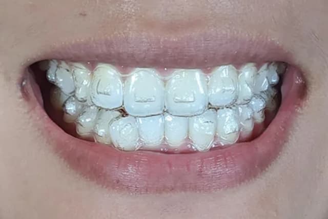 Close-up of a smile wearing clear Invisalign aligners on upper and lower teeth.