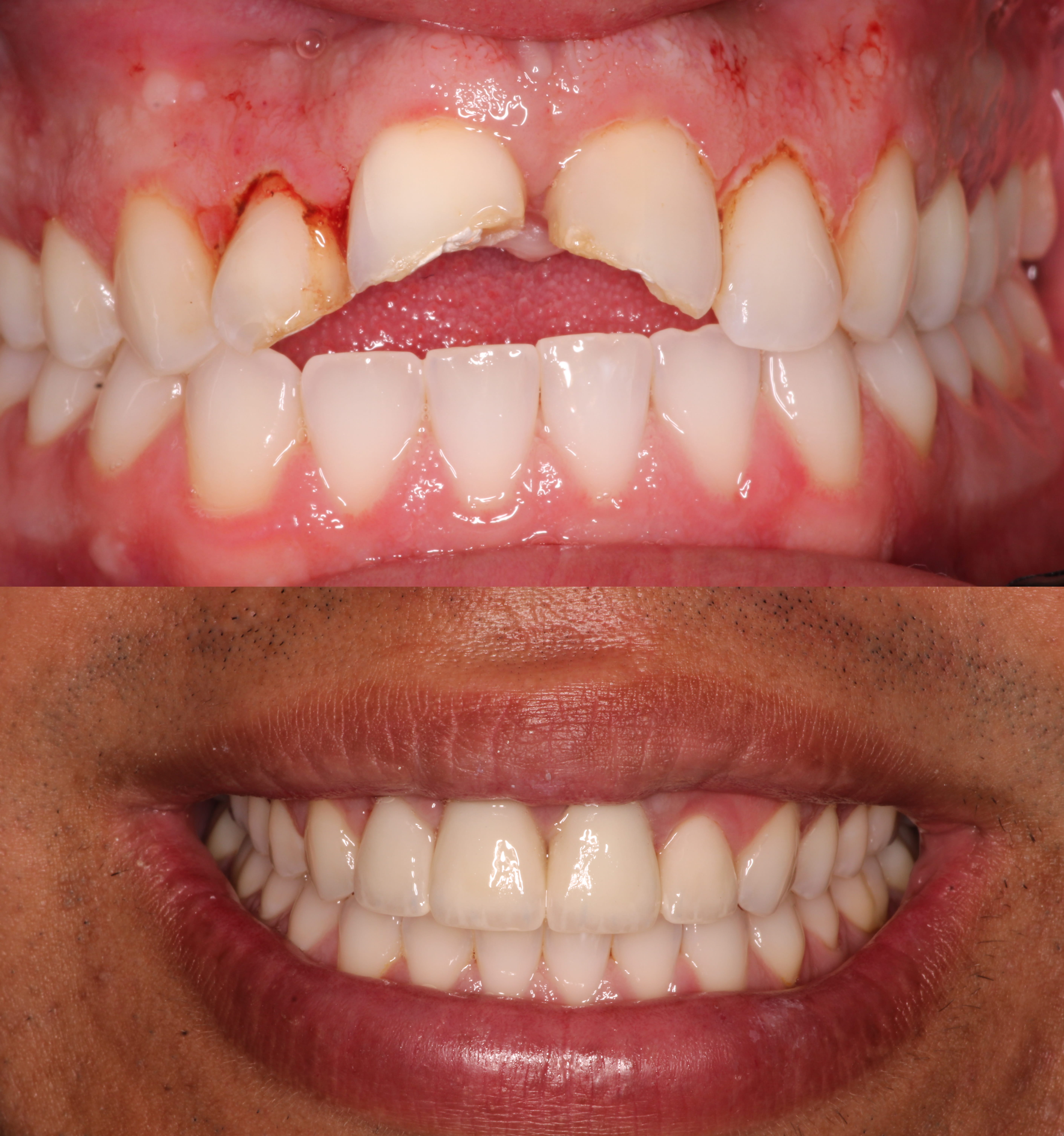 Before and after photos showing a smile with broken teeth restored to healthy, aligned teeth.