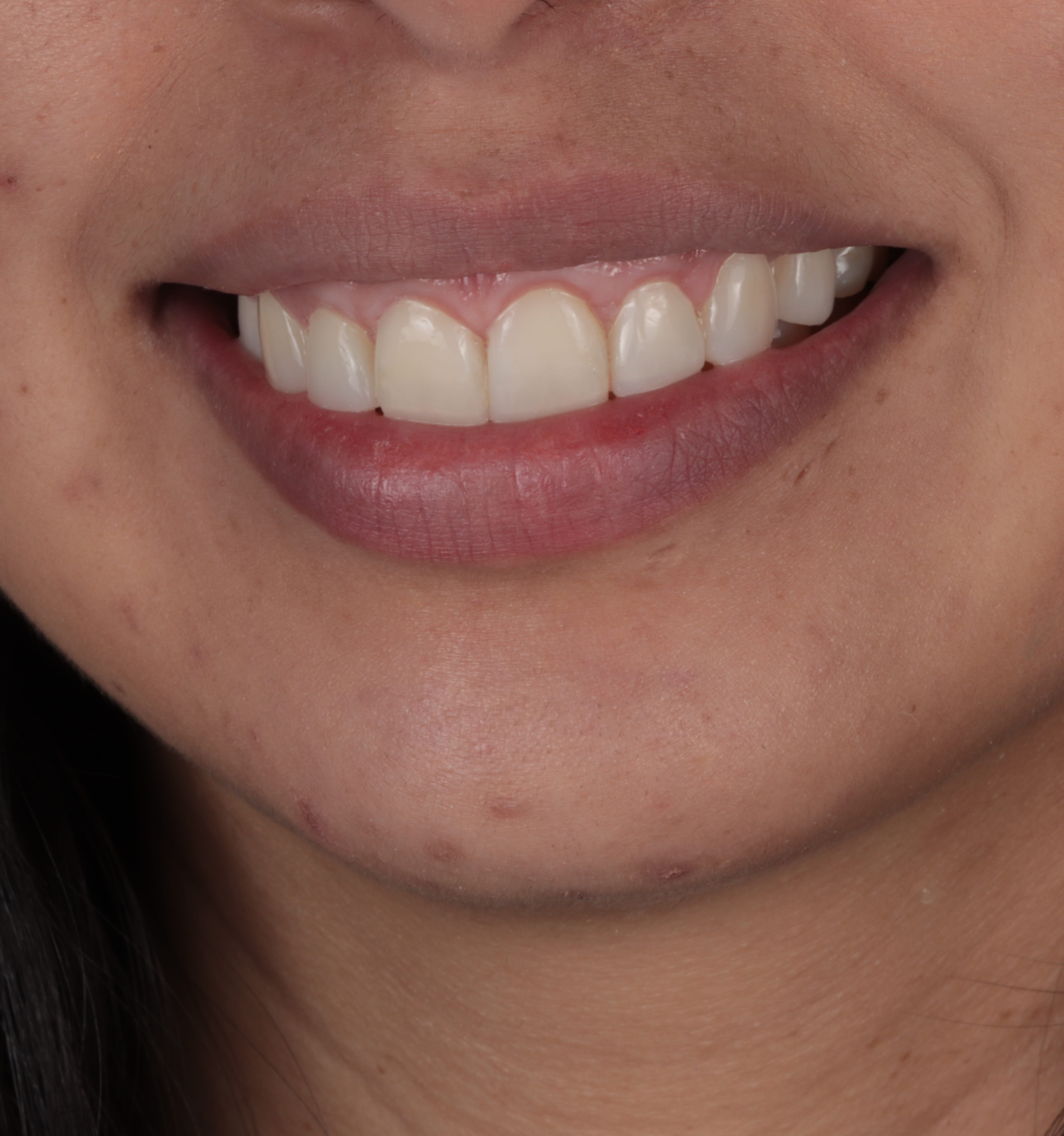 Close-up of a smiling mouth showing clean white teeth and natural lips.