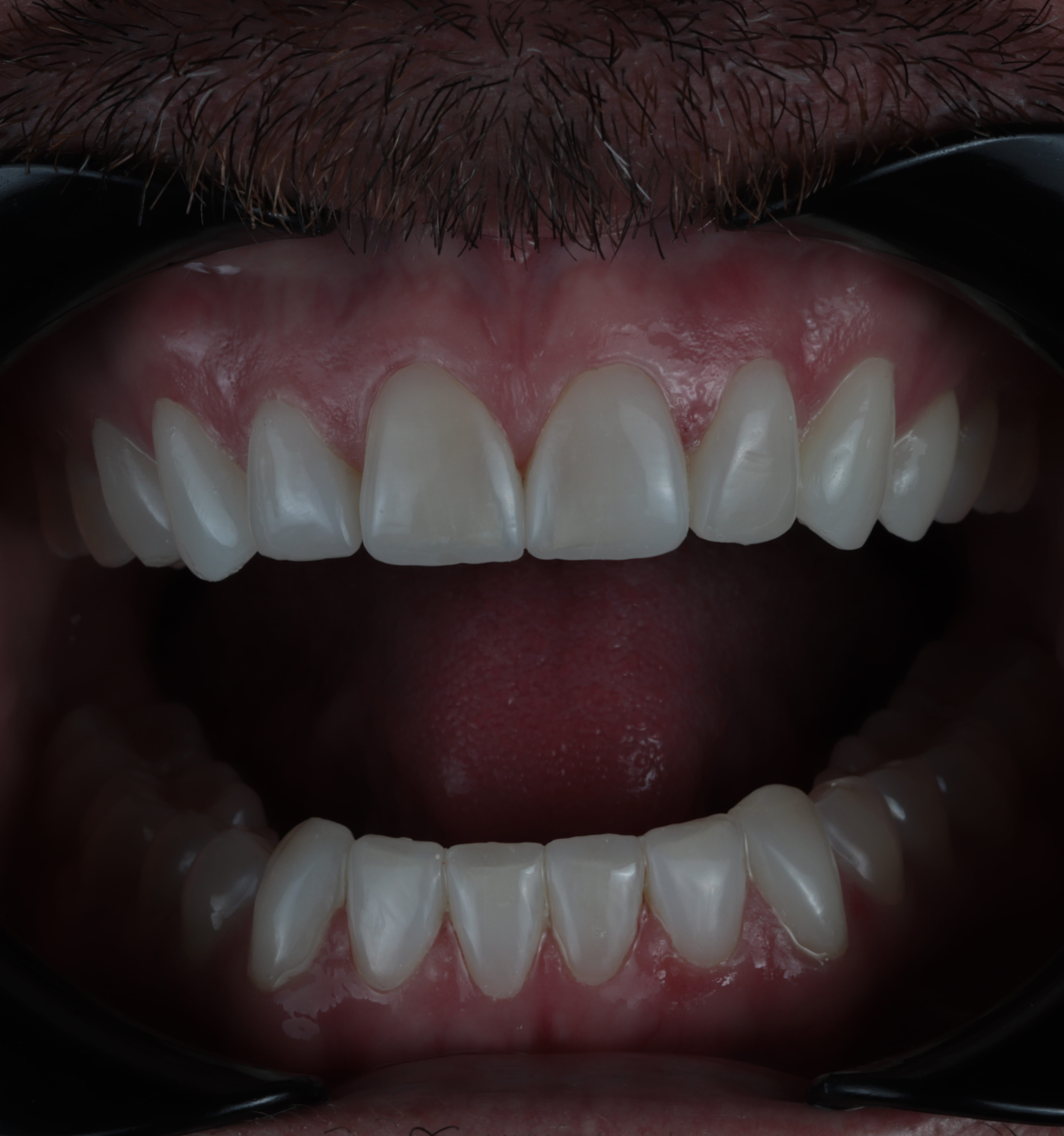 Close-up of open mouth showing upper and lower front teeth and gums with dental cheek retractors.