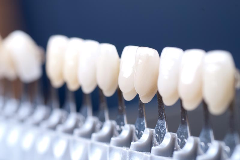 Composite Veneers in Toronto